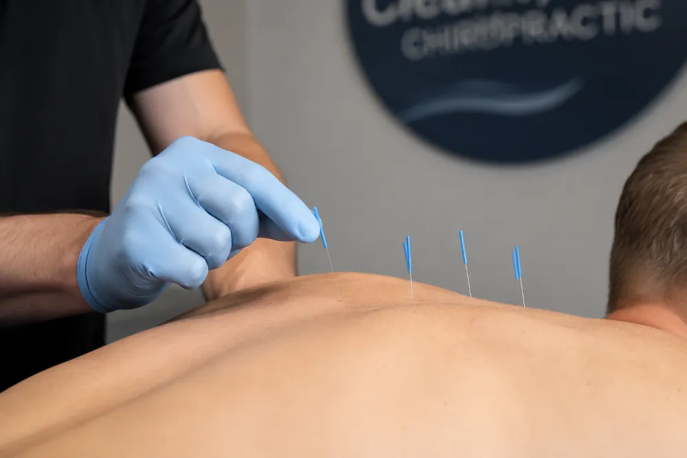 Dry needling treatment performed by Dr. Flood at Clearwater Chiropractic in Eau Claire, WI